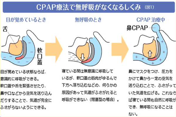 ＣＰＡＰ療法で無呼吸がなくなる仕組み